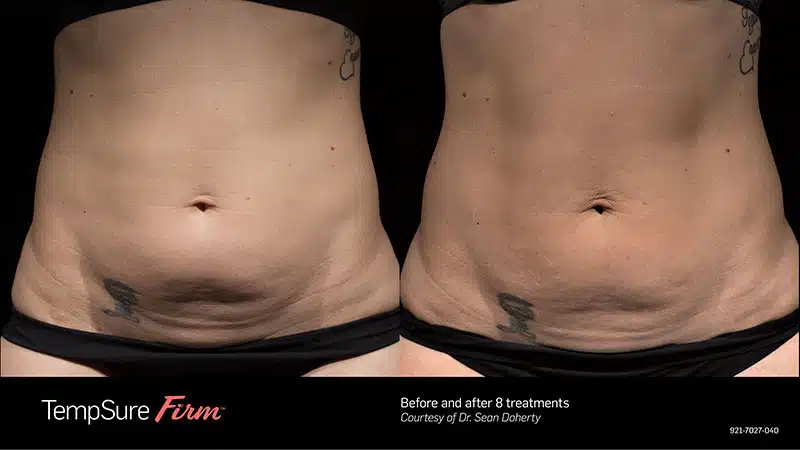 Before and after belly photo of TempSure in Boston | Boston Plastic Surgery by Dr, Sean Doherty