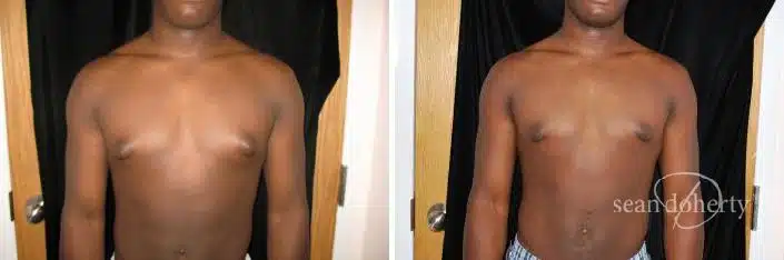 Gynecomastia Before and After Photos in Boston, MA, Patient 2489