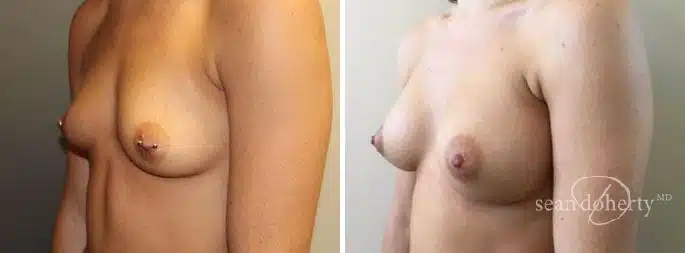 Patient 3193, Breast Augmentation Before and After Photos Breast Augmentation Before and After Photos in Boston, MA, Patient 3193