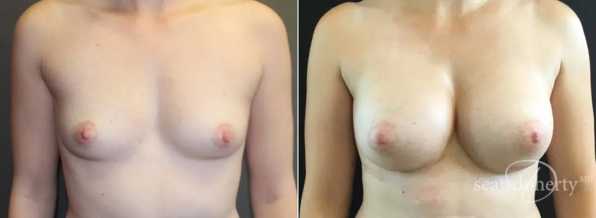 Breast Augmentation Before and After Photos in Boston, MA, Patient 5674