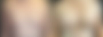 Breast Augmentation Before and After Photos in Boston, MA, Patient 5674