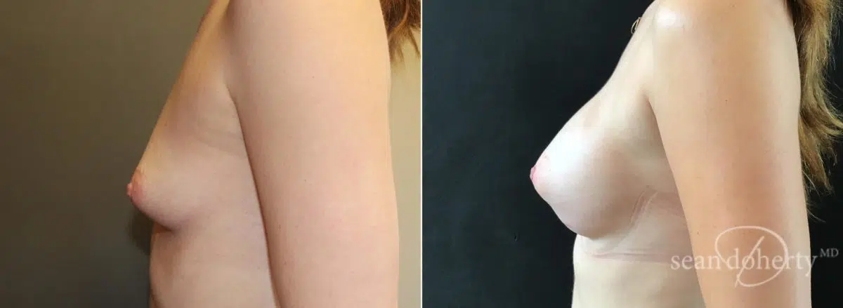 Breast Augmentation Before and After Photos in Boston, MA, Patient 5674