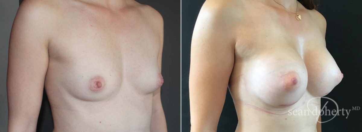 Breast Augmentation Before and After Photos in Boston, MA, Patient 5674