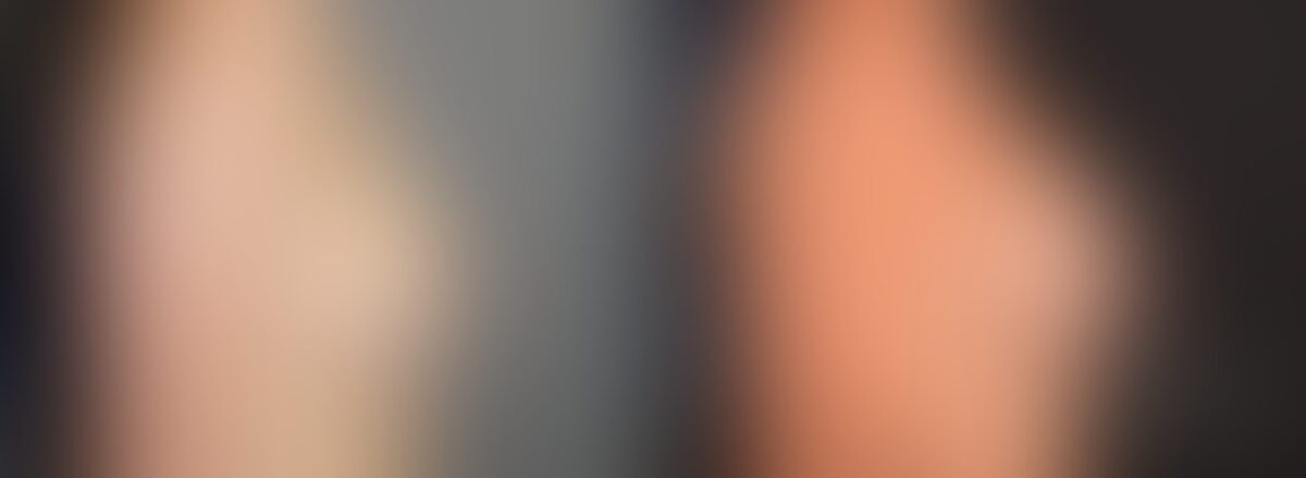 Breast Augmentation Before and After Photos in Boston, MA, Patient 5684