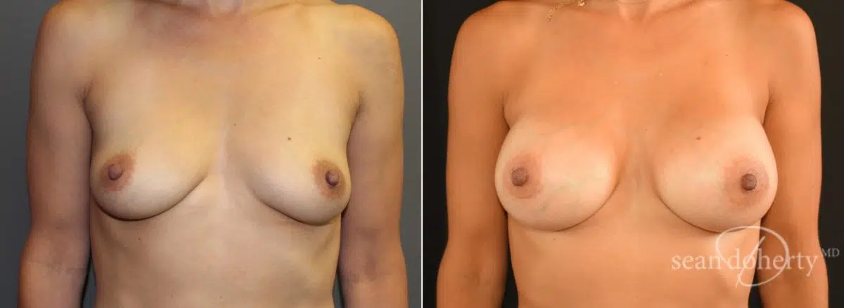 Breast Augmentation Before and After Photos in Boston, MA, Patient 5684