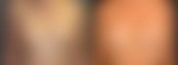 Breast Augmentation Before and After Photos in Boston, MA, Patient 5684