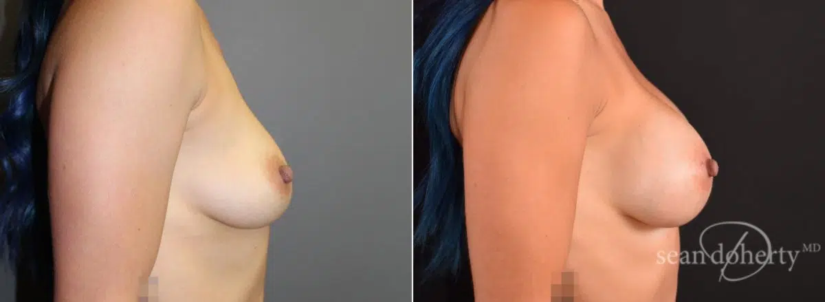 Breast Augmentation Before and After Photos in Boston, MA, Patient 5684