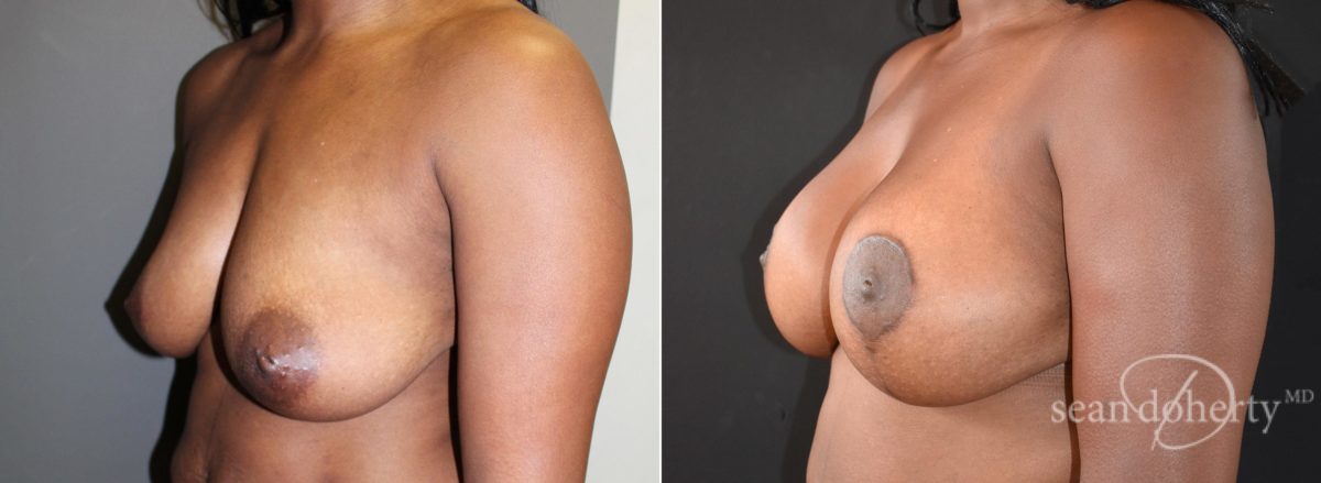 Breast Lift with Implants Before and After Photos in Boston, MA, Patient 5700