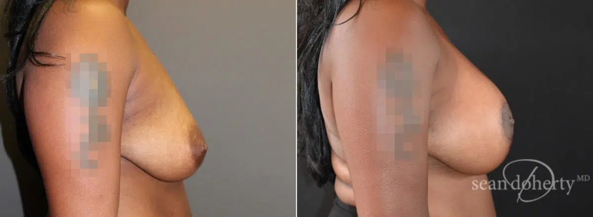 Breast Lift with Implants Before and After Photos in Boston, MA, Patient 5700