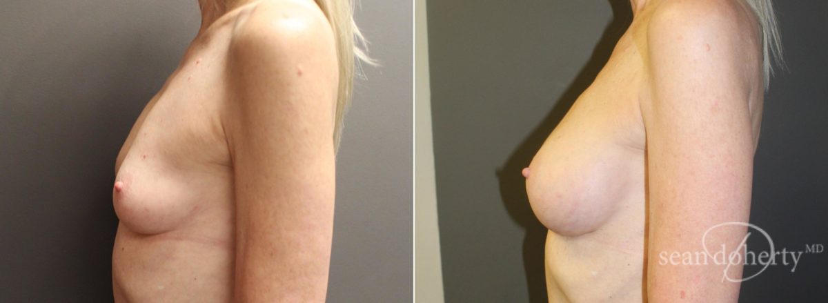 Breast Augmentation Before and After Photos in Boston, MA, Patient 5710