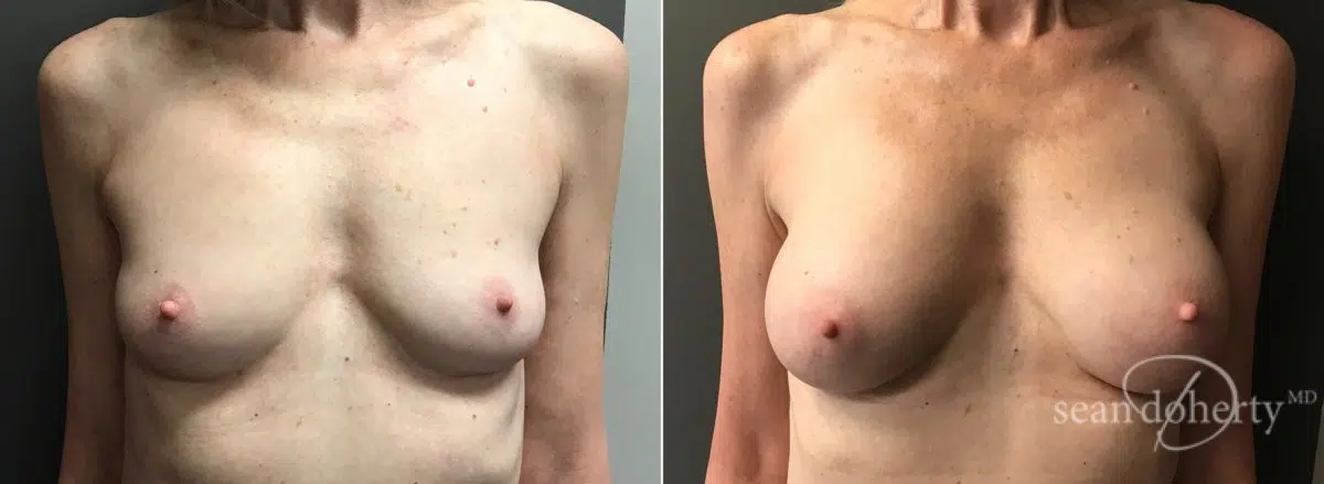 Breast Augmentation Before and After Photos in Boston, MA, Patient 5710