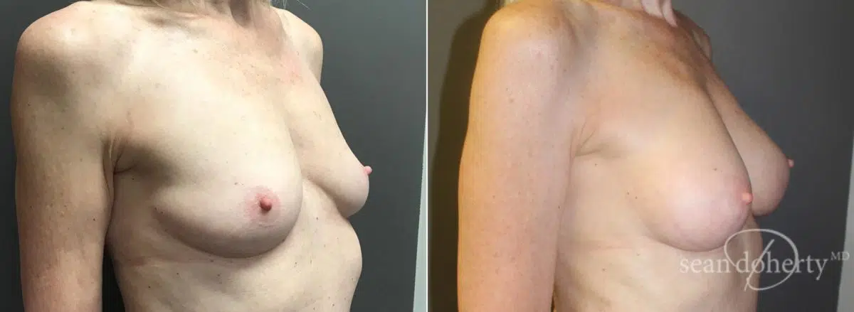 Breast Augmentation Before and After Photos in Boston, MA, Patient 5710