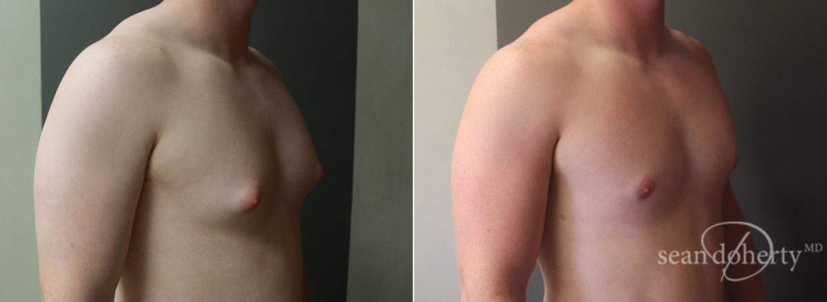 Gynecomastia Before and After Photos in Boston, MA, Patient 5720