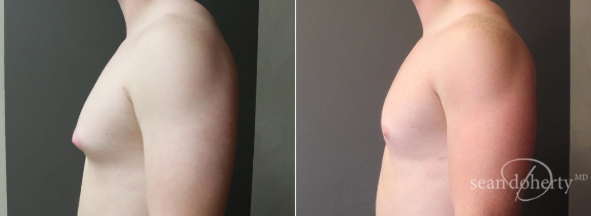 Gynecomastia Before and After Photos in Boston, MA, Patient 5720