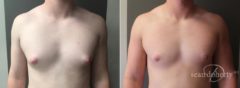 Gynecomastia Before and After Photos in Boston, MA, Patient 5720