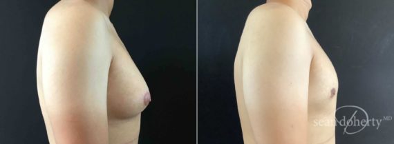 Gynecomastia Before and After Photos in Boston, MA, Patient 5730