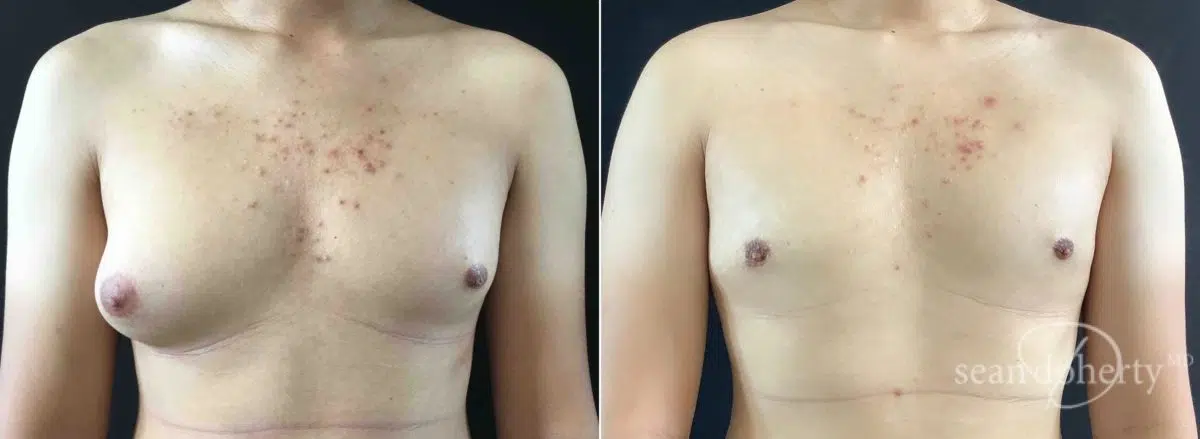 Gynecomastia Before and After Photos in Boston, MA, Patient 5730