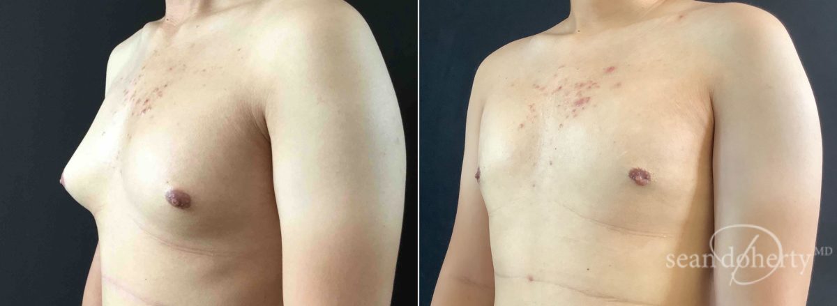 Gynecomastia Before and After Photos in Boston, MA, Patient 5730