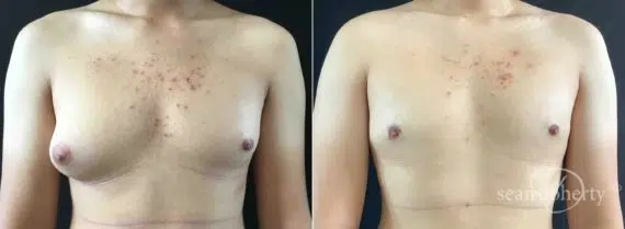 Gynecomastia Before and After Photos in Boston, MA, Patient 5730