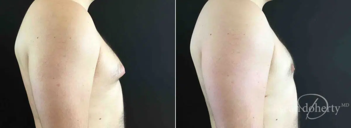 Gynecomastia Before and After Photos in Boston, MA, Patient 5740