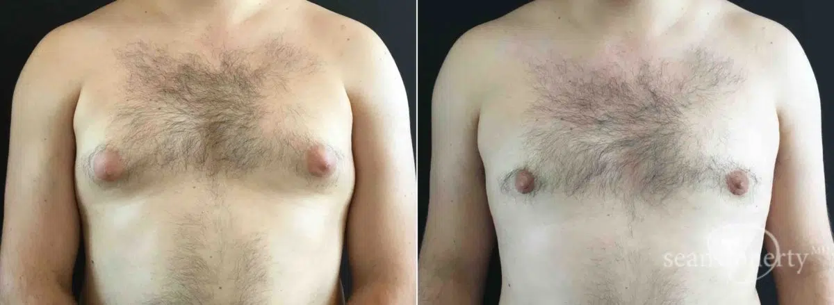 Gynecomastia Before and After Photos in Boston, MA, Patient 5740