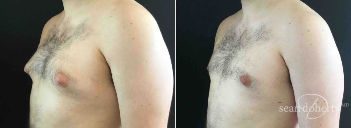 Gynecomastia Before and After Photos in Boston, MA, Patient 5740