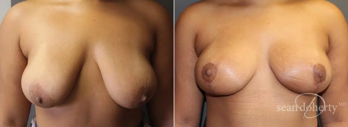 Breast Lift Before and After Photos in Boston, MA, Patient 5770