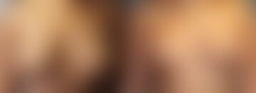 Breast Lift Before and After Photos in Boston, MA, Patient 5770
