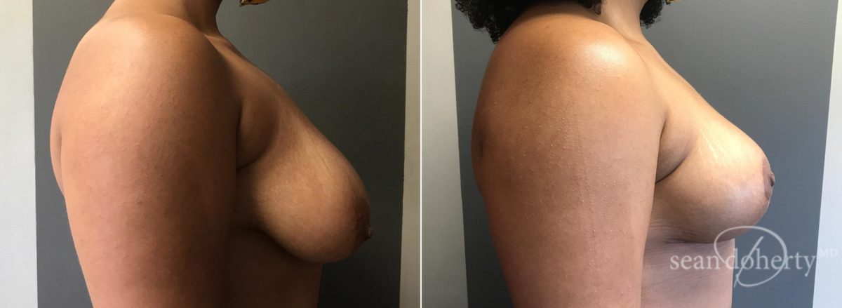 Breast Lift Before and After Photos in Boston, MA, Patient 5770