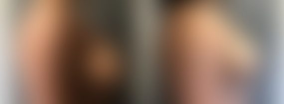 Breast Lift Before and After Photos in Boston, MA, Patient 5770