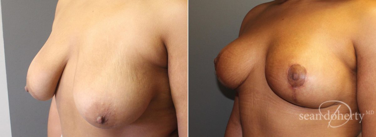 Breast Lift Before and After Photos in Boston, MA, Patient 5770