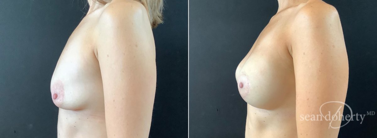 Breast Lift with Implants Before and After Photos in Boston, MA, Patient 5780