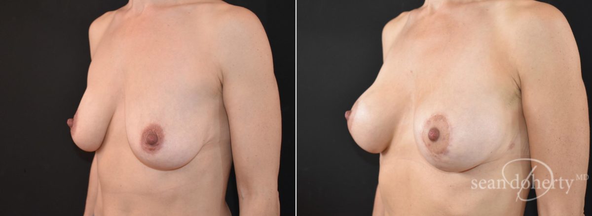 Patient 5790, Breast Augmentation Before and After Photos Breast Augmentation Before and After Photos in Boston, MA, Patient 5790