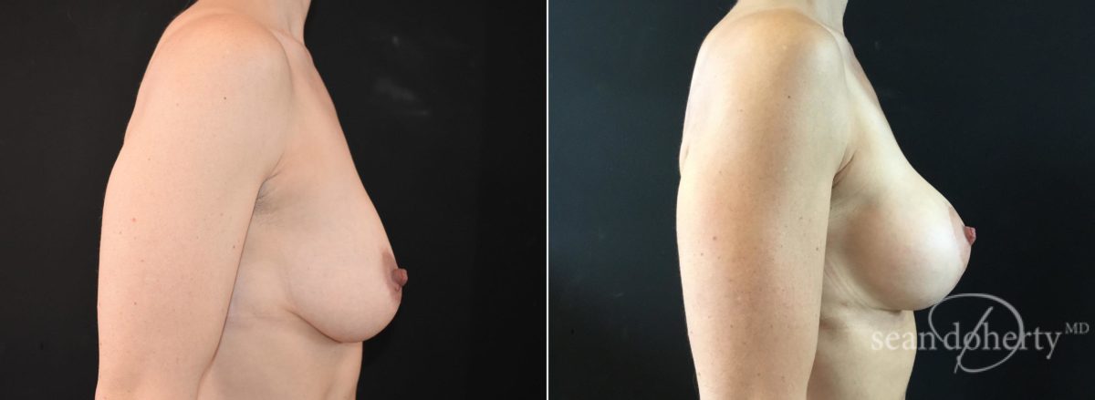 Patient 5790, Breast Augmentation Before and After Photos Breast Augmentation Before and After Photos in Boston, MA, Patient 5790