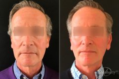 Facelift Before and After Photos in Boston, MA, Patient 5800