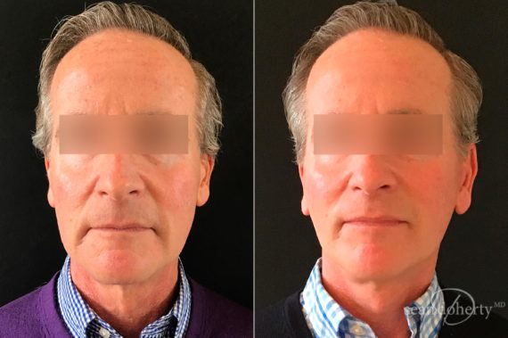 Facelift Before and After Photos in Boston, MA