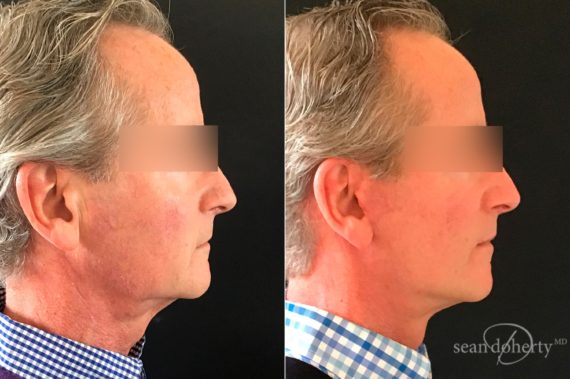 Facelift Before and After Photos in Boston, MA, Patient 5800