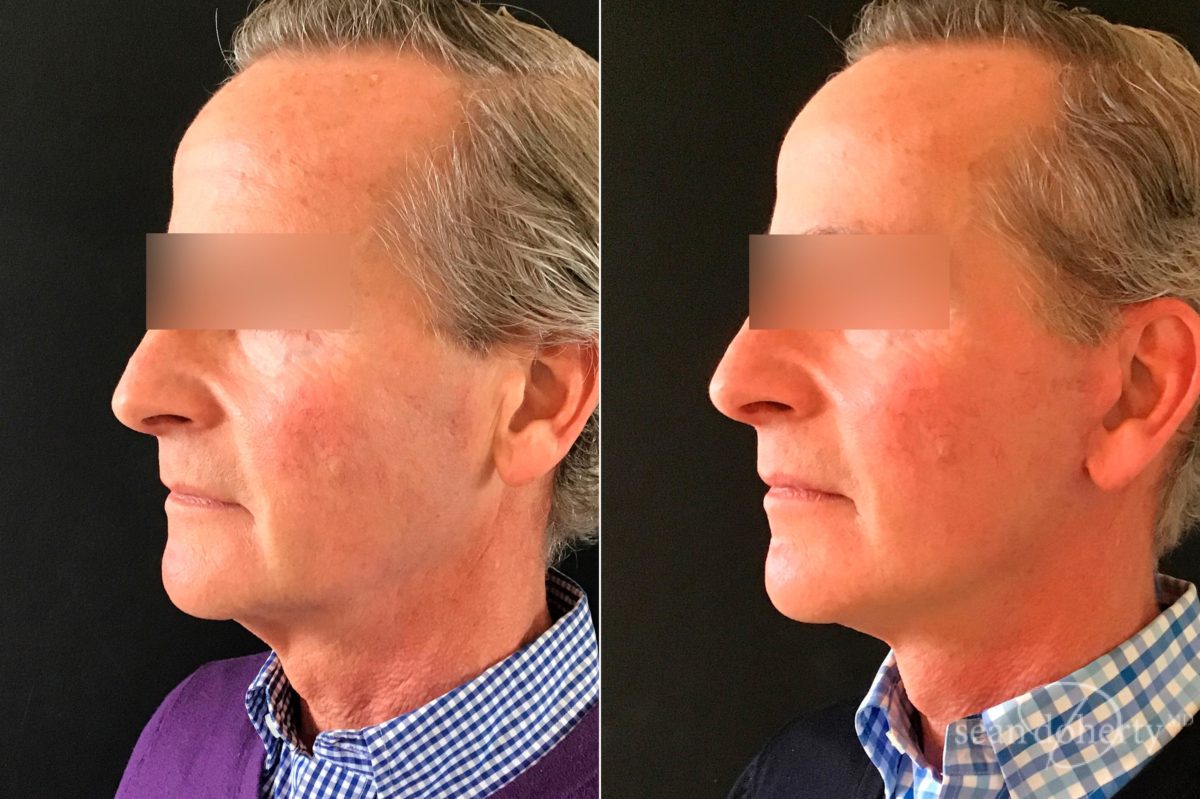 Facelift Before and After Photos in Boston, MA, Patient 5800