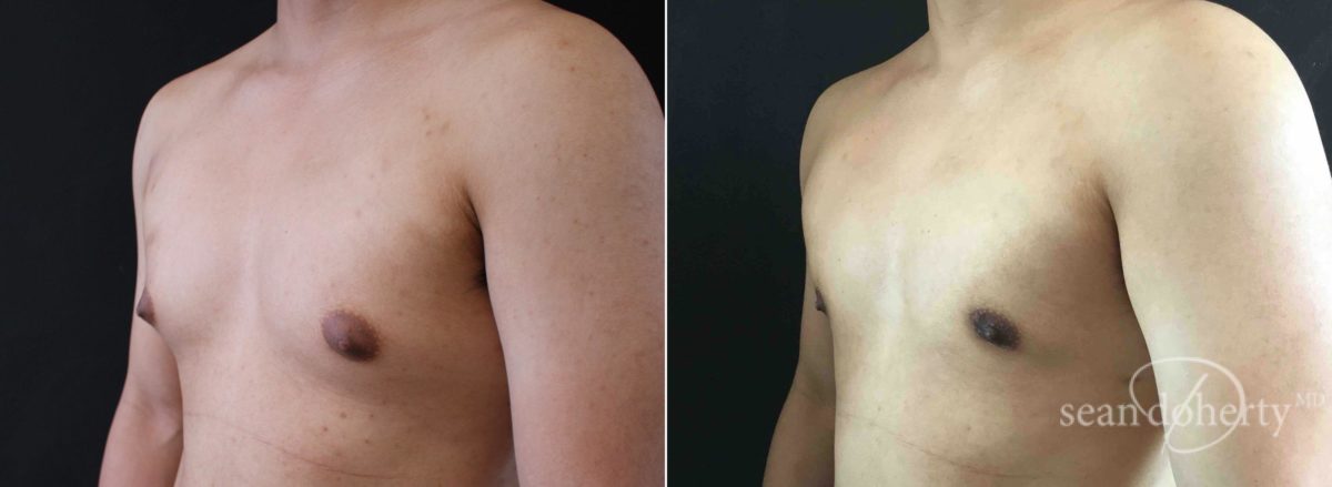 Gynecomastia Before and After Photos in Boston, MA, Patient 5810