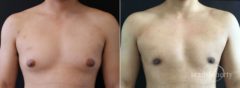 Gynecomastia Before and After Photos in Boston, MA, Patient 5810