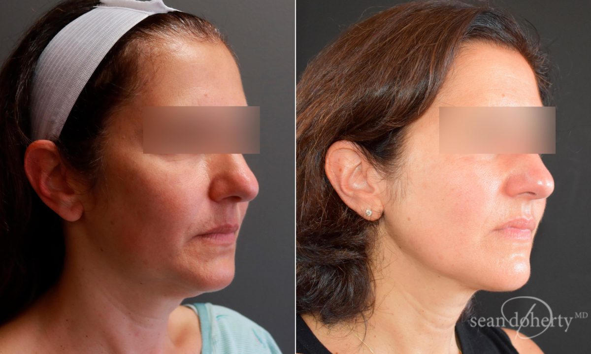 Patient 5820, Liposuction Before and After Photos Liposuction Before and After Photos in Boston, MA, Patient 5820