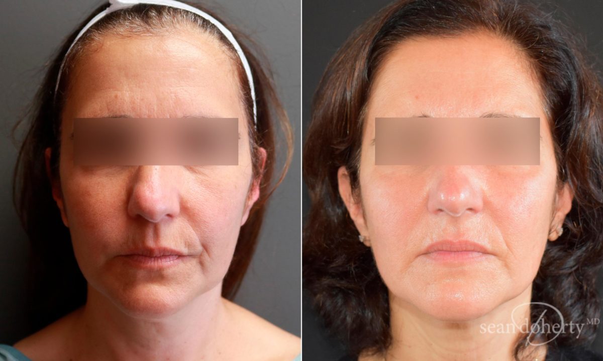 Patient 5820, Liposuction Before and After Photos Liposuction Before and After Photos in Boston, MA, Patient 5820