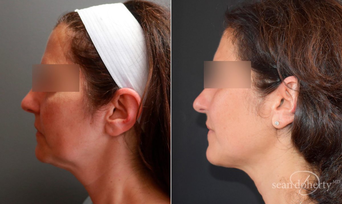 Patient 5820, Liposuction Before and After Photos Liposuction Before and After Photos in Boston, MA, Patient 5820