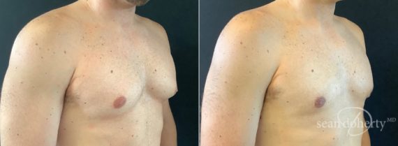 Gynecomastia Before and After Photos in Boston, MA, Patient 5830