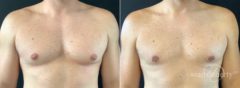 Gynecomastia Before and After Photos in Boston, MA, Patient 5830