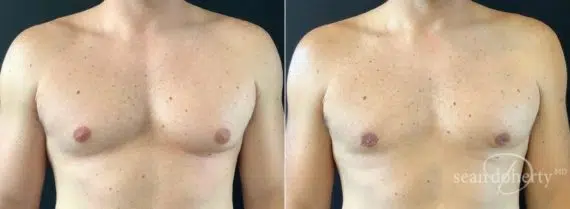 Gynecomastia Before and After Photos in Boston, MA