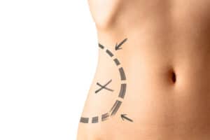 Liposuction is a surgical procedure that reshapes the body, giving you the body profile that you've always wanted. Dr, Sean Doherty | Boston, MA.
