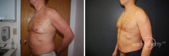 Liposuction Before and After Photos in Boston, MA, Patient 2551