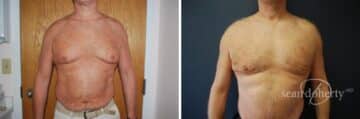 Liposuction Before and After Photos in Boston, MA, Patient 2551