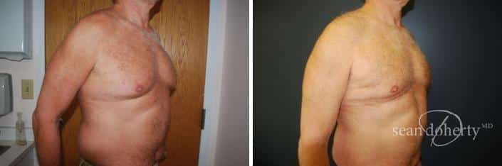 Patient 2551, Liposuction Before and After Photos Liposuction Before and After Photos in Boston, MA, Patient 2551